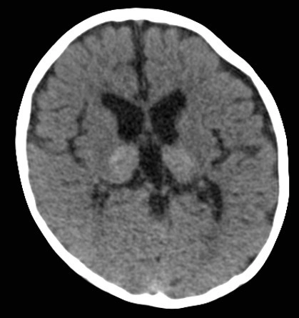 Bệnh loạn dưỡng chất trắng tế bào hình cầu (Globoid Cell Leukodystrophy)/ Bệnh Krabbe