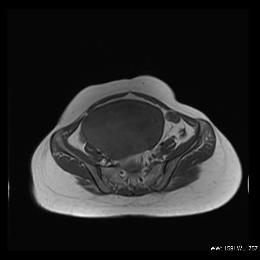 U túi noãn hoàng buồng trứng (Ovarian yolk sac tumor)