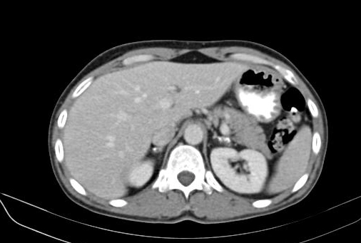 Suy thượng thận (Adrenal insufficiency)