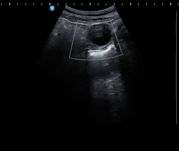 Nang noãn buồng trứng (Ovarian follicular cyst)