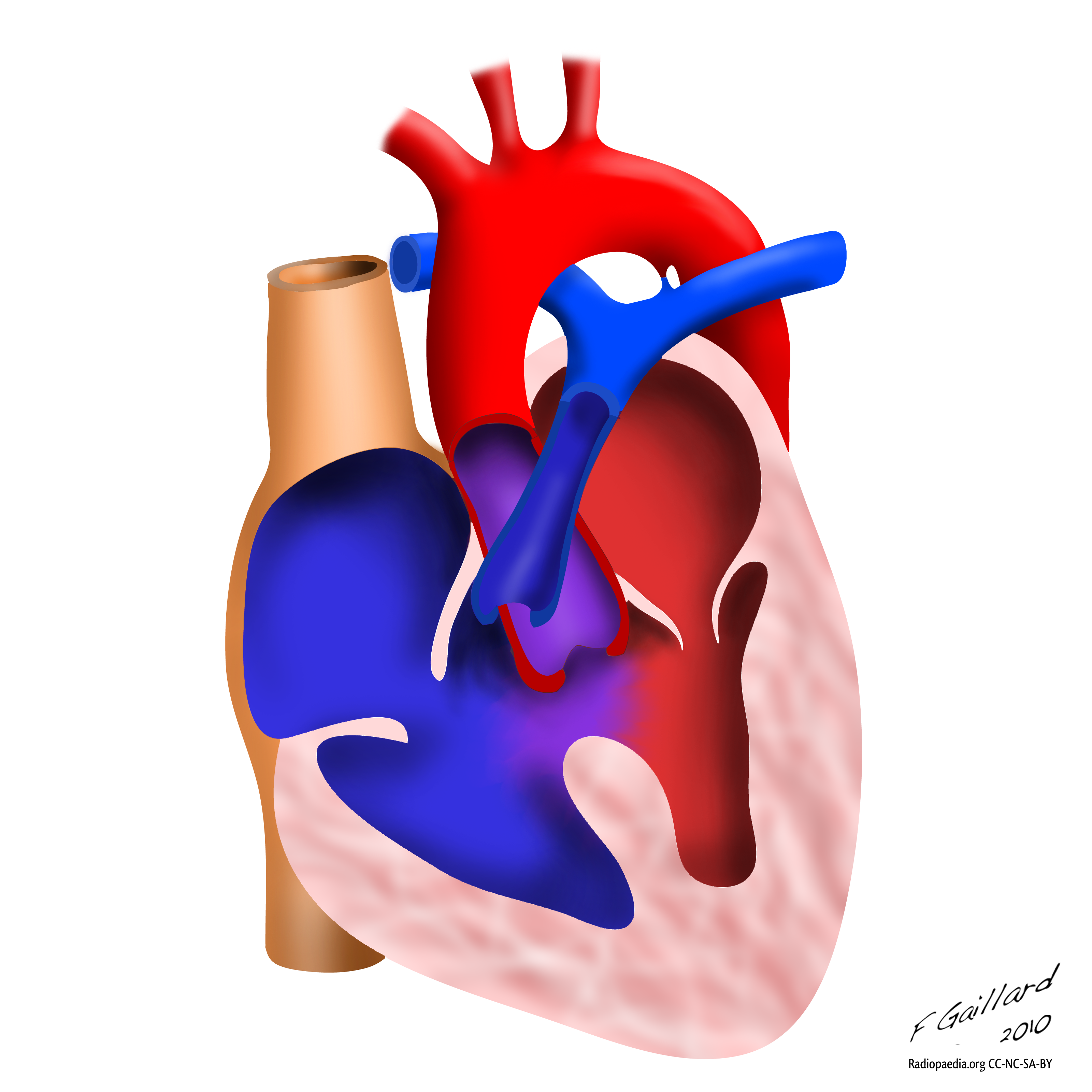 Tứ chứng Fallot (Tetralogy of Fallot - TOF)