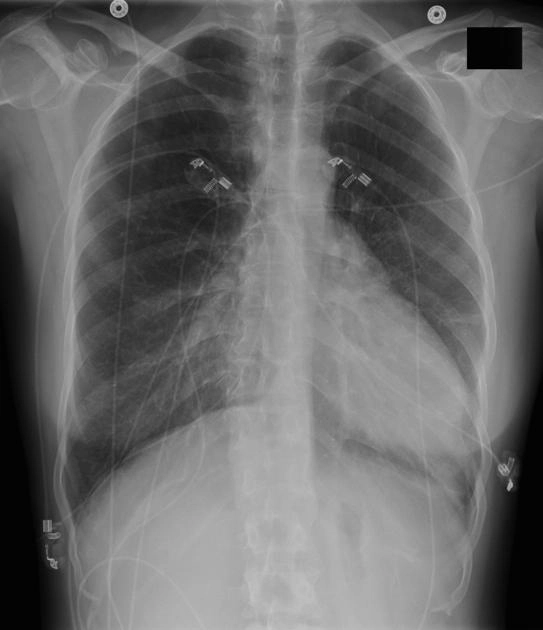 Bất sản màng ngoài tim (Pericardial Agenesis) 