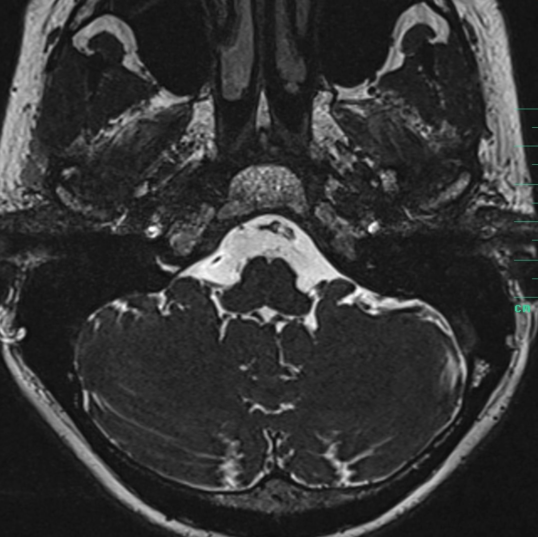 Schwannoma trong mê nhĩ (Intralabyrinthine schwannomas)