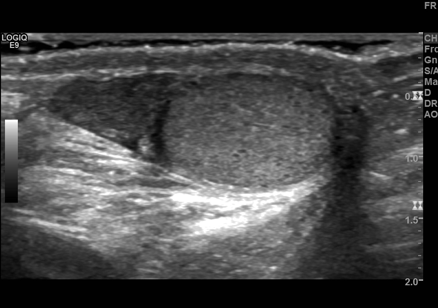 Xoắn mấu phụ tinh hoàn (Torsion of the appendix testis)