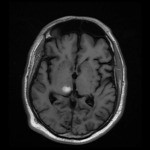 Nhồi máu não đa ổ do thuyên tắc (Multiple Embolic Cerebral Infarctions)