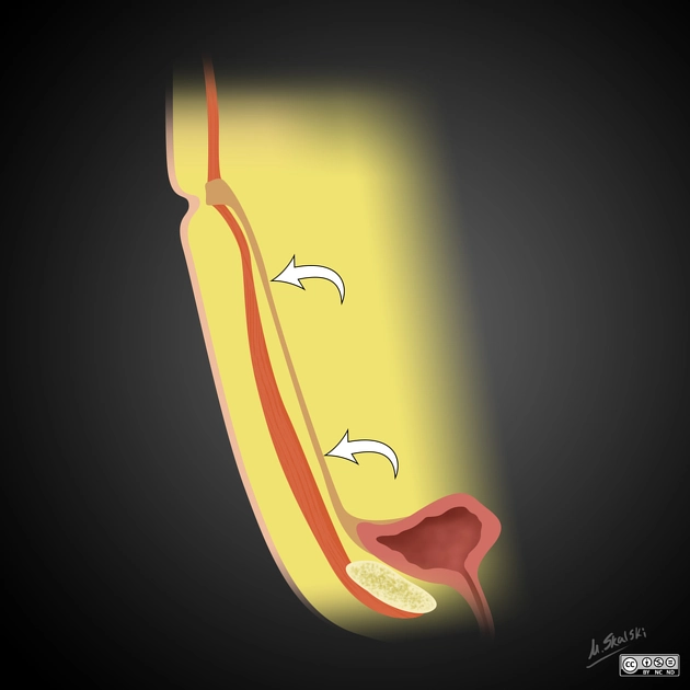 Ống niệu-rốn (Congenital urachal anomalies)