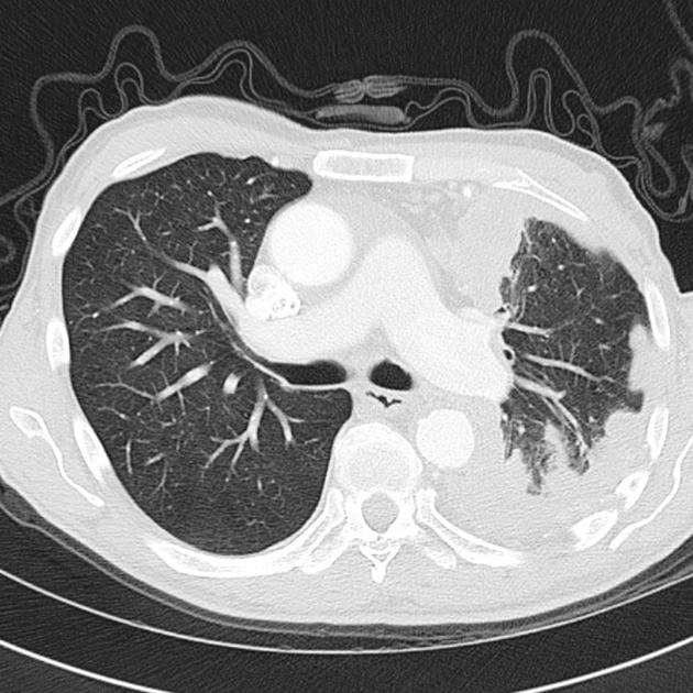 U trung biểu mô màng phổi ác tính (Malignant Pleural Mesothelioma - MPM)