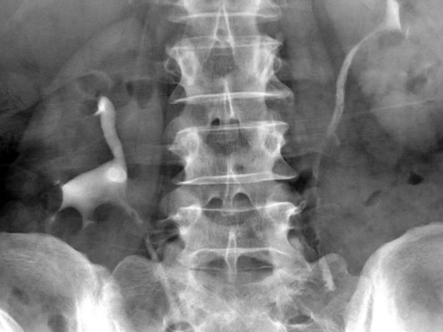 Viêm niệu quản dạng nang (Ureteritis cystica)