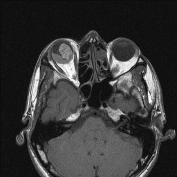 Melanoma ác tính màng bồ đào (Primary uveal malignant melanoma)