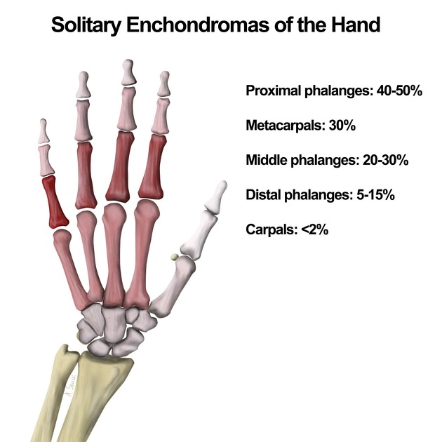 U sụn (Enchondroma)