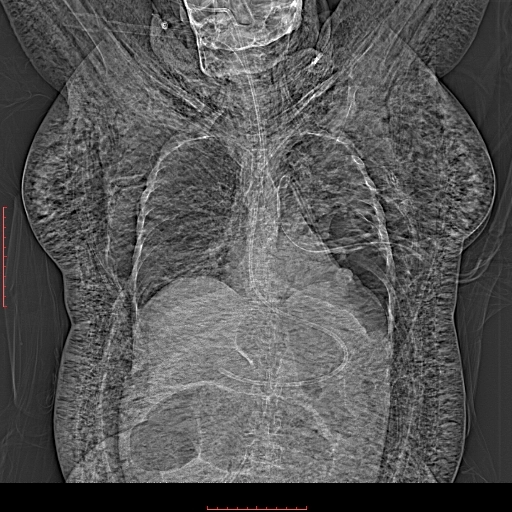 Tràn khí dưới da (Subcutaneous Emphysema)