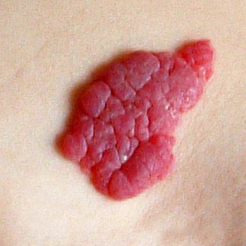 U máu mao mạch ổ mắt (Capillary hemangiomas of the orbit)