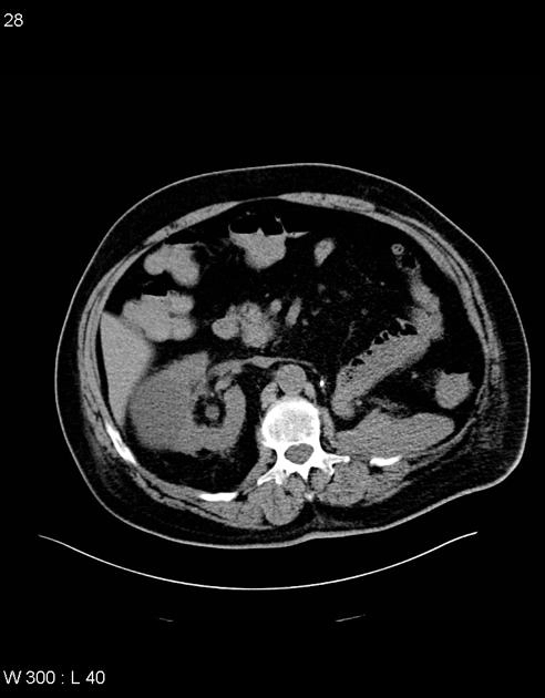 U di căn tụy (Pancreatic Metastases)