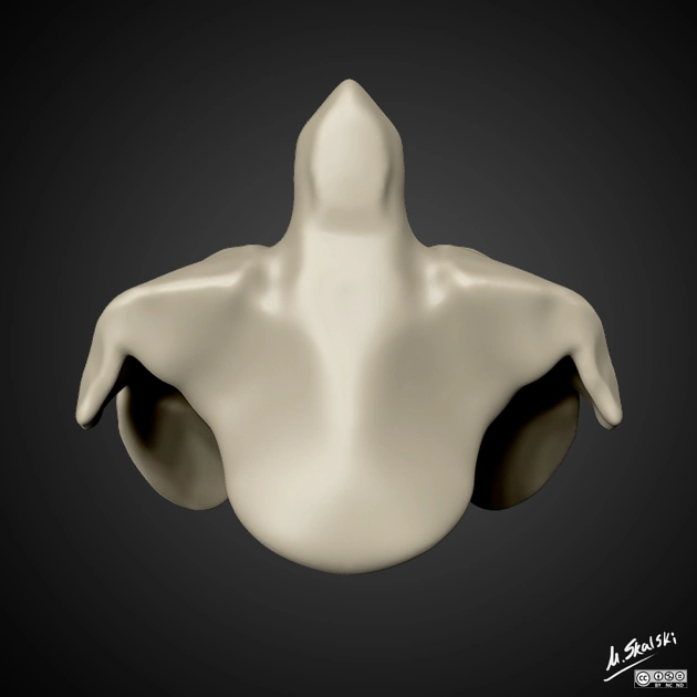 Tồn tại xương phụ mỏm răng (Persistent ossiculum terminale)