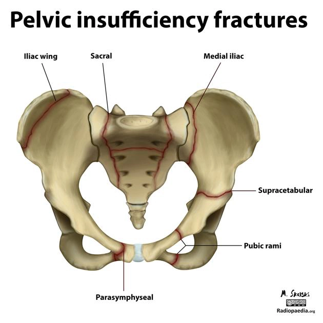 Gãy xương chậu do suy yếu (Pelvic insufficiency fracture)/ Gãy xương chậu do stress