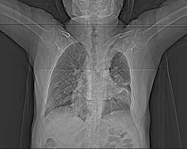 U thần kinh nội tiết của phổi (Pulmonary neuroendocrine tumors)