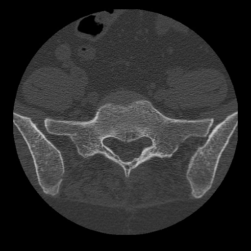 Thắt lưng hóa S1/ Cùng hóa L5