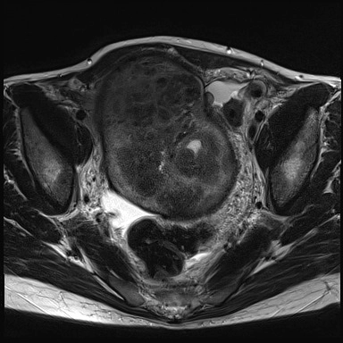 U vỏ buồng trứng (Ovarian thecoma)