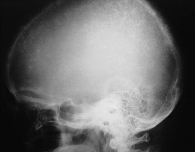 Cường tuyến cận giáp ở sọ (Hyperparathyroidism)