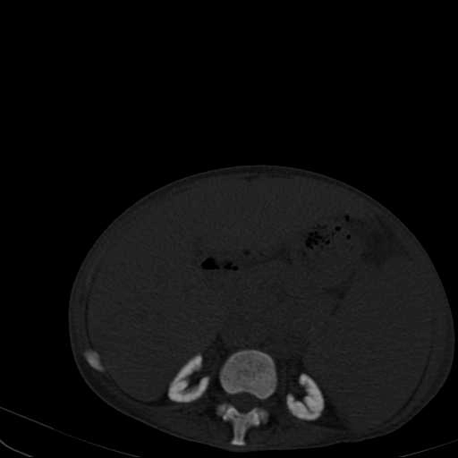 Bệnh nhiễm độc Fluoride ở xương (Skeletal fluorosis)