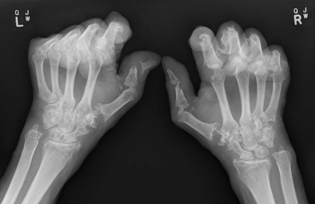 Viêm đa khớp mô bào lưới (Multicentric Reticulohistiocytosis - MRH)