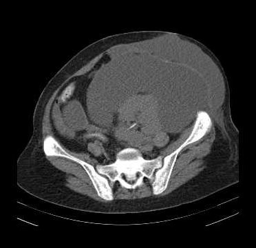 Nang bạch huyết quanh thận (Perirenal lymphocele)