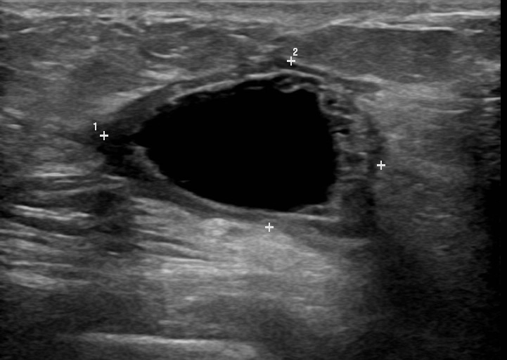 Sẹo sau phẫu thuật vú (Post surgical breast scar)