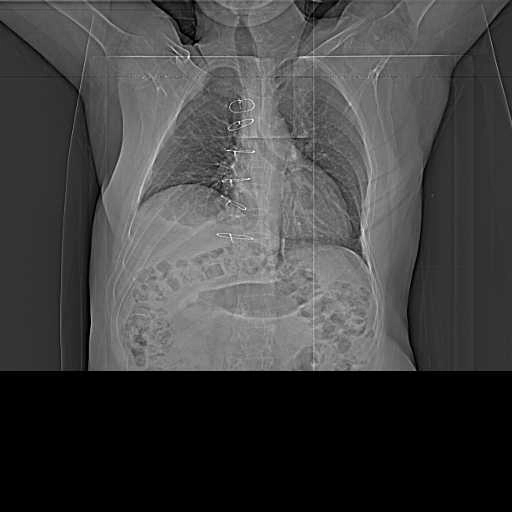 Tăng sản tuyến thượng thận (Adrenal hyperplasia)