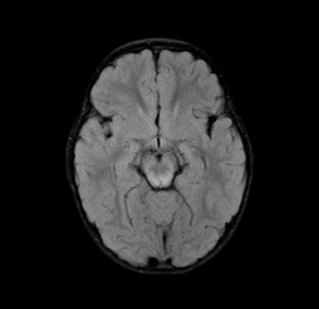  Rối loạn ty thể nguyên phát (Primary mitochondrial disorders - PMDs) 