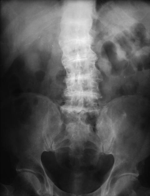 Bệnh khớp do Ochronosis (Alkapton niệu)