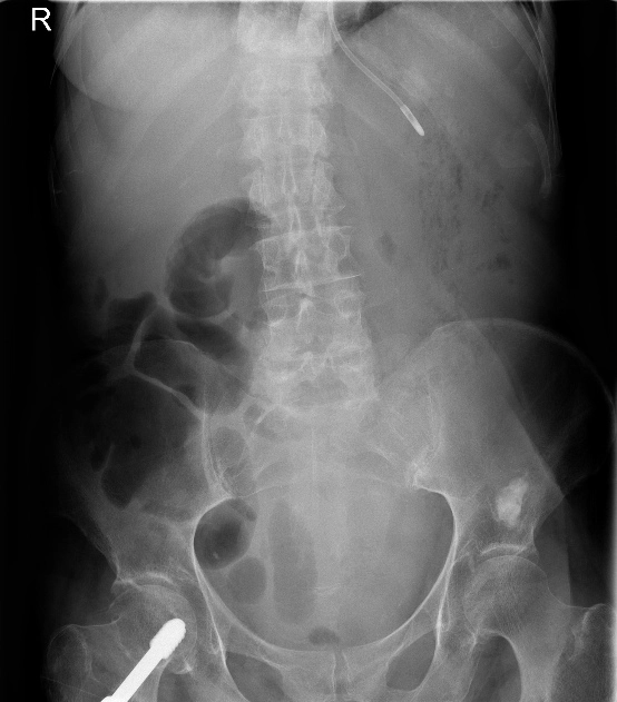 Khí trong thành dạ dày (Gastric emphysema)