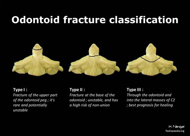 Gãy mỏm răng C2 (Odontoid fracture)