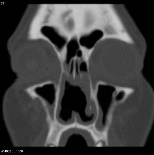 Thủng vách ngăn mũi (Nasal septal perforation)