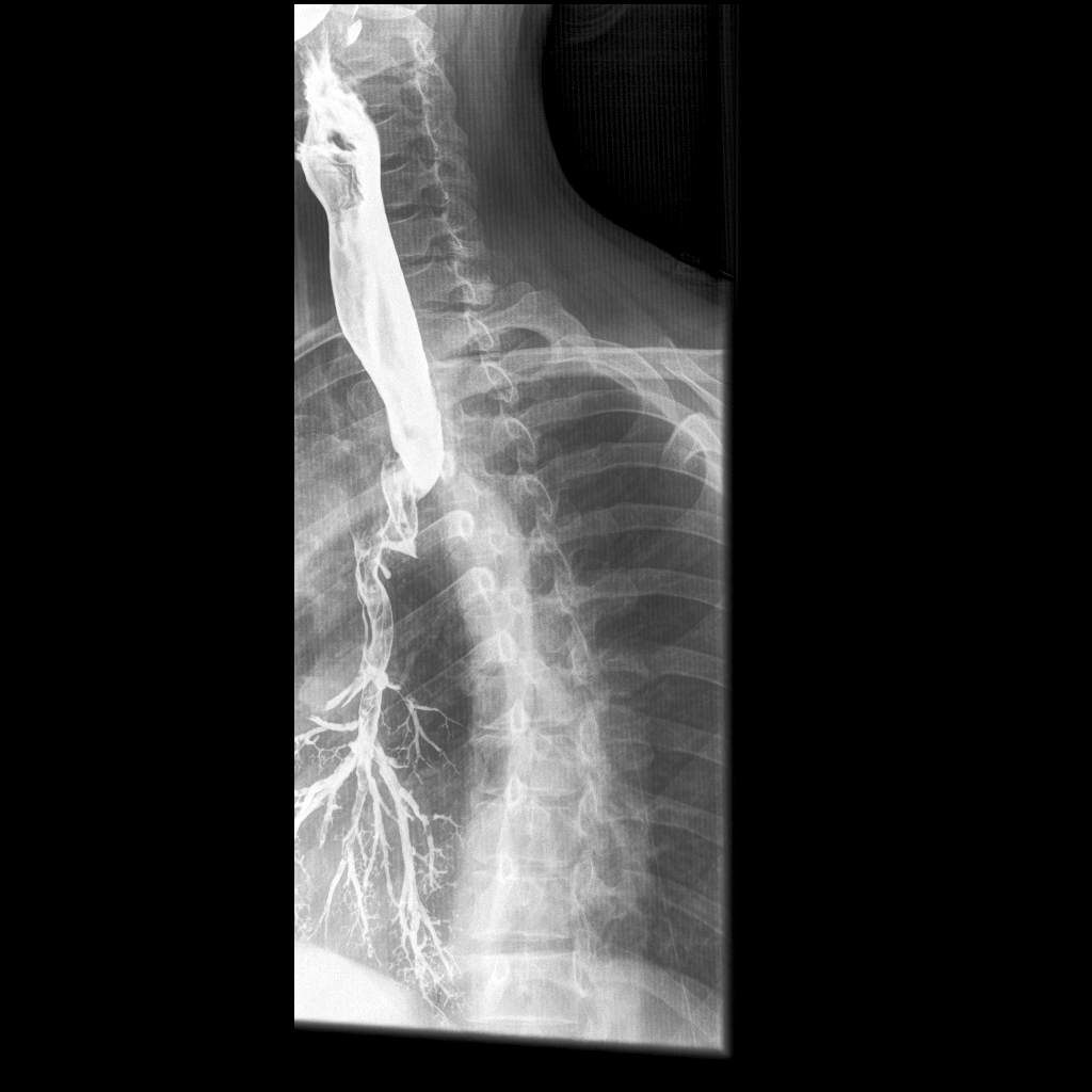 Rò thực quản - khí quản thứ phát (Acquired tracheo-esophageal fistula)