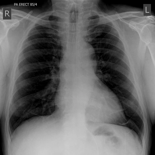 Đường truyền và ống thông (trên X-quang) - Lines and tubes (radiograph)