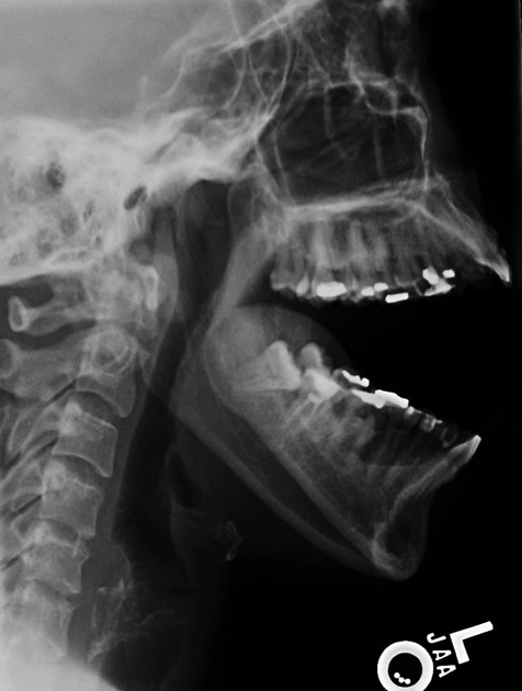 Trật khớp thái dương hàm (Temporomandibular joint dislocation)