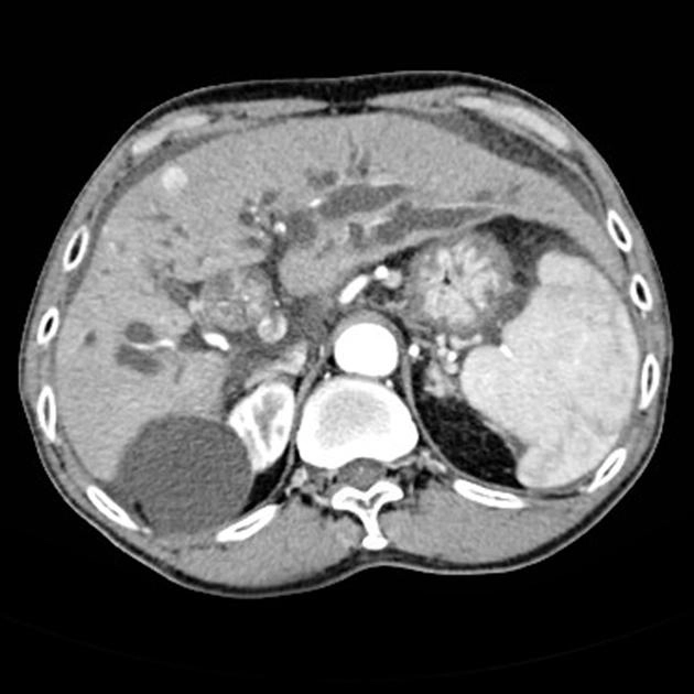Ung thư đường mật (Cholangiocarcinoma)