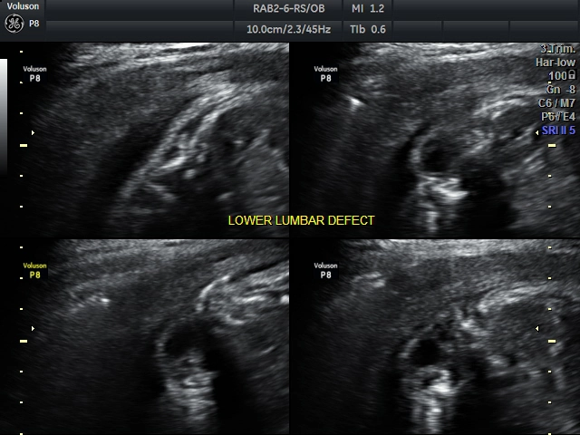 Thoát vị màng tủy bẩm sinh (Congenital spinal meningocele)