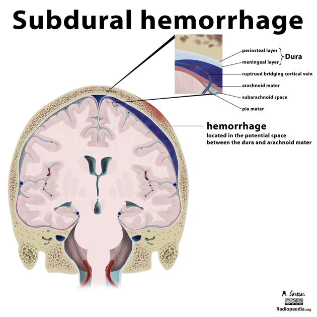 Xuất huyết/Tụ máu dưới màng cứng (Subdural Hemorrhage/Hematoma - SDH)