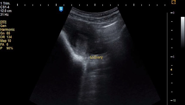 Thai ngoài tử cung trong ổ bụng