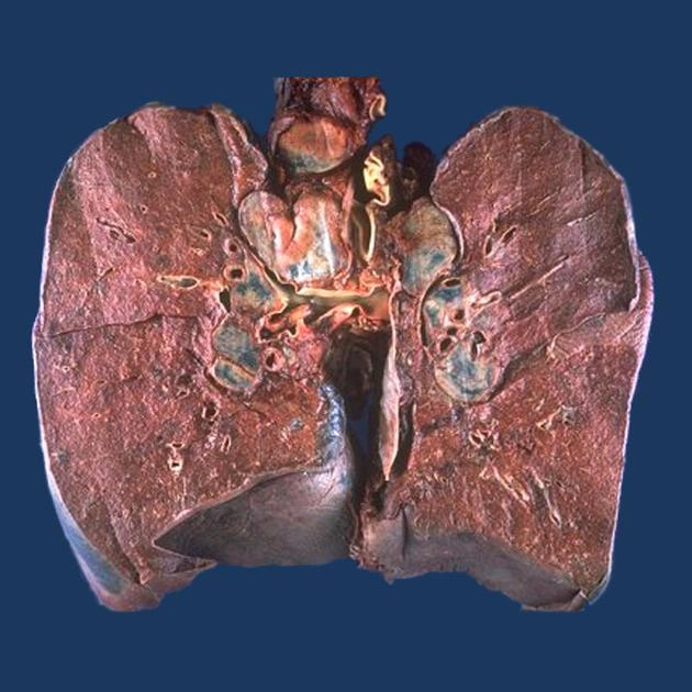  Sarcoidosis phổi (thoracic manifestations)