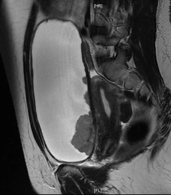 Phân loại giai đoạn ung thư của bàng quang (Transitional cell carcinoma of the bladder (staging))