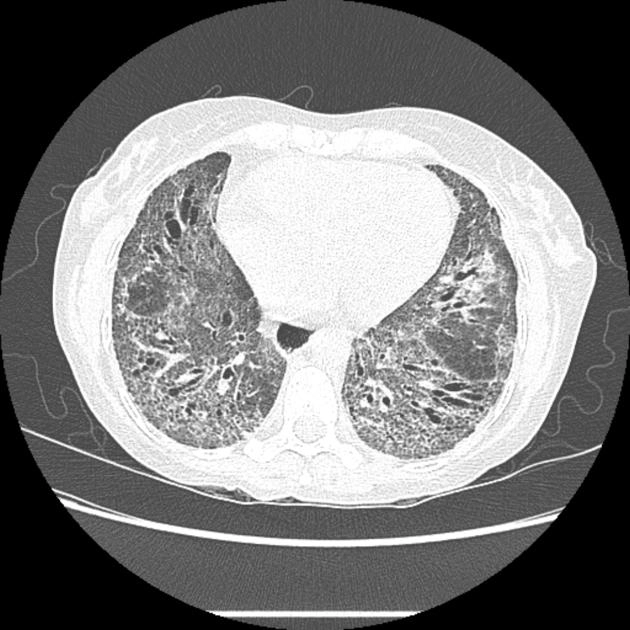 Xơ cứng bì (biểu hiện ở phổi) - Scleroderma (pulmonary manifestations)