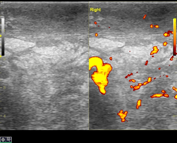 Viêm mô tế bào bìu (Scrotal cellulitis)