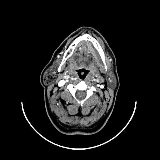 Áp xe dưới hàm (Submandibular abscess)