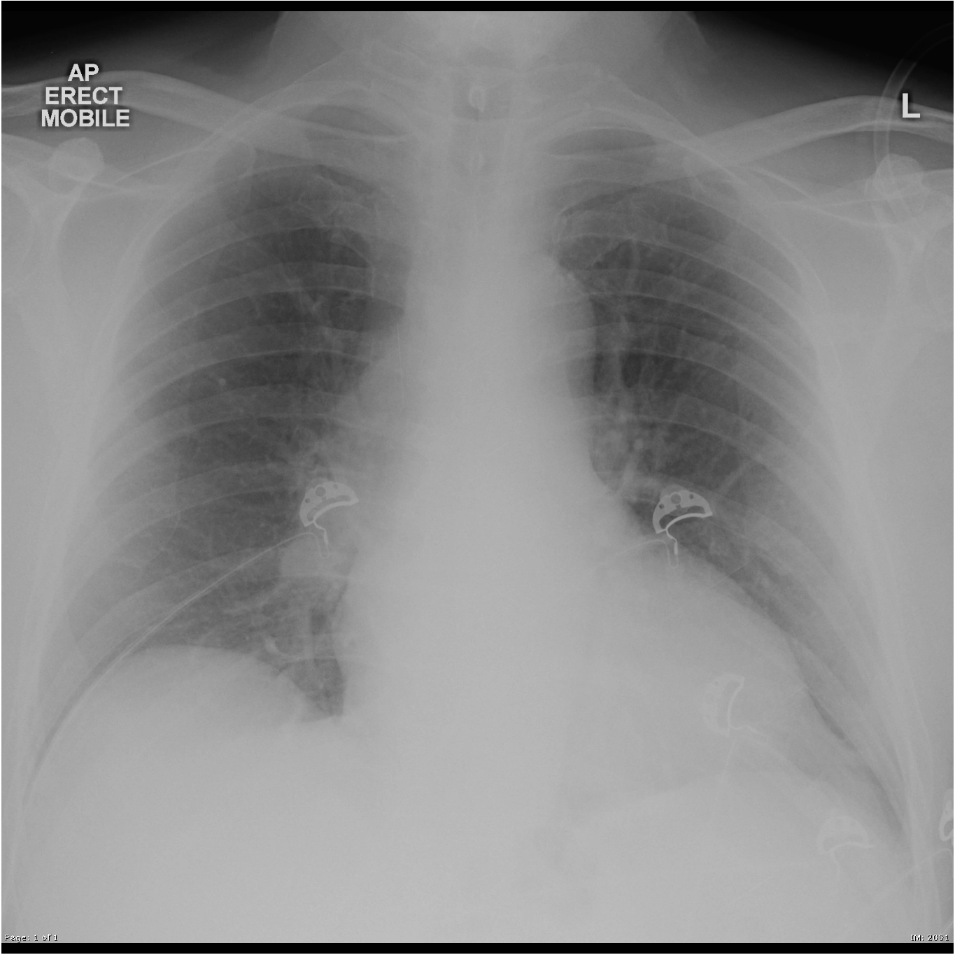 Dấu hiệu Fleischner (Fleischner sign (enlarged pulmonary artery))