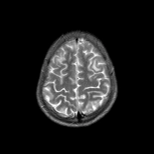 Lupus thần kinh trung ương  (Systemic lupus erythematosus - CNS manifestations)
