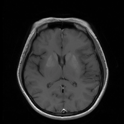 Múa giật nửa người do tăng đường huyết không nhiễm ceton (Non-ketotic Hyperglycemic Hemichorea - NHH)