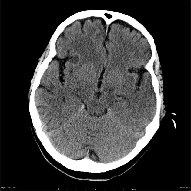 Phù độc tế bào (Cytotoxic Cerebral Edema)