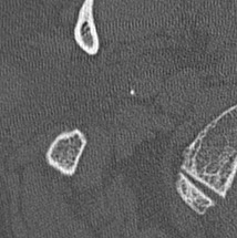 U túi nội bạch huyết (Endolymphatic sac tumors - ELST)